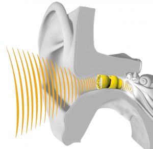 Benefits of Lyric Hearing Aid