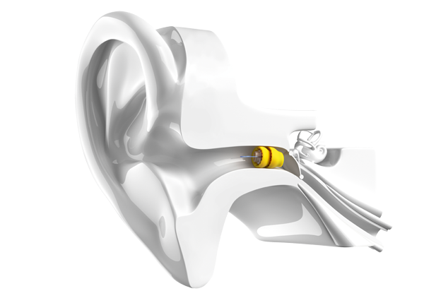 7 Benefits of the Phonak Lyric Hearing Aid | Hearing Solutions
