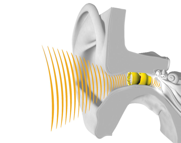 Phonak lyric hearing aid